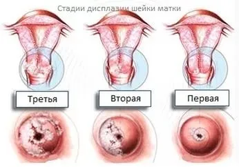 Передракові захворювання шийки матки (захворювання) Передракові захворювання шийки матки