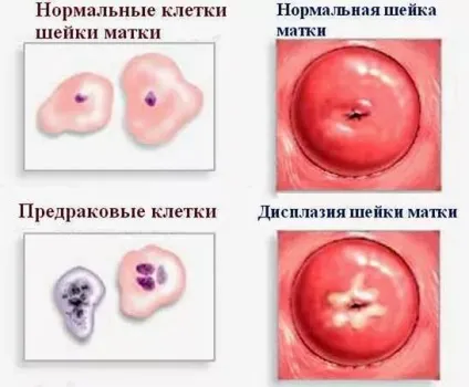 Передракові захворювання шийки матки (передракових захворювань шийки) Передракові захворювання шийки матки