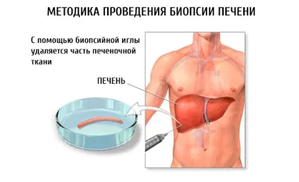 Пункційна біопсія печінки показання, техніка і ускладнення, компетентно про здоров'я на ilive (ускладнення) Пункційна біопсія печінки показання, техніка і ускладнення, компетентно про здоров'я на ilive