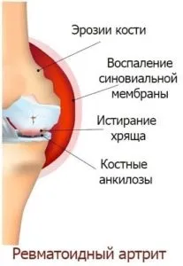 Ревматоїдний артрит колінного суглоба симптоми і лікування