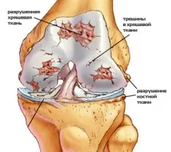 Ревматоїдний артрит колінного суглоба - що це і як лікується патологія (артрит) Ревматоїдний артрит колінного суглоба - що це і як лікується патологія