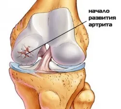 Ревматоїдний артрит колінного суглоба - що це і як лікується патологія (ревматоїдний) Ревматоїдний артрит колінного суглоба - що це і як лікується патологія