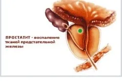 Найефективніші трави від простатиту (ефективні) Найефективніші трави від простатиту
