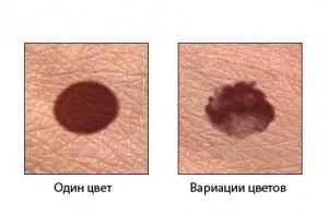 Саркома шкіри, симптоми ознаки, лікування (саркома) Саркома шкіри, симптоми ознаки, лікування