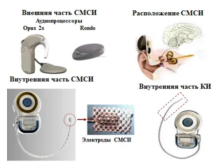 Санкт-петербурзький ванні вуха, горла, носа й мови, стволомозговая імплантація (мови) Санкт-петербурзький ванні вуха, горла, носа й мови, стволомозговая імплантація