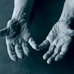 Симптоми, діагностика та лікування синдрому Марфана (арахнодактіліі) (синдром Марфана причини) Симптоми, діагностика та лікування синдрому Марфана (арахнодактіліі)