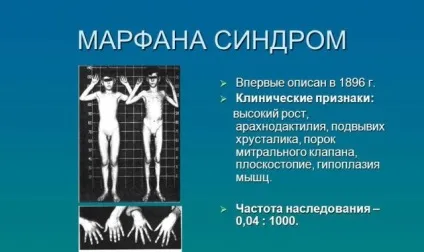 Симптоми, діагностика та лікування синдрому Марфана (арахнодактіліі) (синдром Марфана діагностика) Симптоми, діагностика та лікування синдрому Марфана (арахнодактіліі)