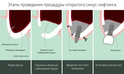 Синус ліфтинг зубів в Москві - ціна, відгуки, фото, відео