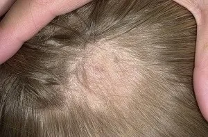Стригучий лишай причини, симптоми і лікування (гладкій поверхні шкіри) Стригучий лишай причини, симптоми і лікування
