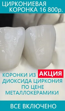 Установка керамічних вінірів на зуби, ціни в павловский посад фото, відгуки, відео, павловській (виниров) Установка керамічних вінірів на зуби, ціни в павловский посад фото, відгуки, відео, павловській