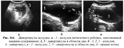 Узі шлунково-кишкового тракту (антральному частини шлунка) Узі шлунково-кишкового тракту