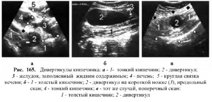 Узі шлунково-кишкового тракту (антральному частини шлунка) Узі шлунково-кишкового тракту