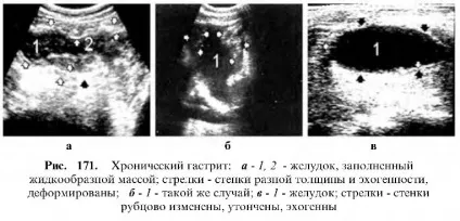 Узі шлунково-кишкового тракту (тракту) Узі шлунково-кишкового тракту