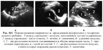Узі шлунково-кишкового тракту (антральному частини шлунка) Узі шлунково-кишкового тракту