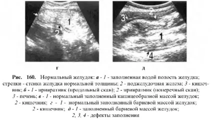Узі шлунково-кишкового тракту (велика кількість рідини) Узі шлунково-кишкового тракту