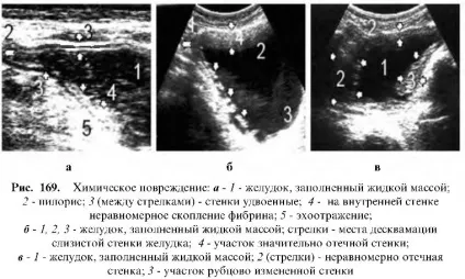 Узі шлунково-кишкового тракту (тракту) Узі шлунково-кишкового тракту