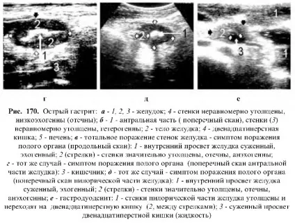 Узі шлунково-кишкового тракту (шлунково-кишкового) Узі шлунково-кишкового тракту
