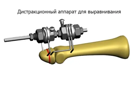 Вивих кисті як проводиться лікування фото і відео (зменшення больового синдрому) Вивих кисті як проводиться лікування фото і відео