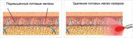 Хірургічне лікування гіпергідрозу - операції в лікуванні пітливості (лікування пітливості) Хірургічне лікування гіпергідрозу - операції в лікуванні пітливості