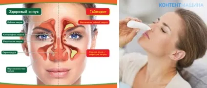 ЯМІК процедура при гаймориті, симптоми і лікування (гаймориті) ЯМІК процедура при гаймориті, симптоми і лікування