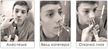 ЯМІК процедура при гаймориті особливості призначення та протипоказання до лікування (гаймориті) ЯМІК процедура при гаймориті особливості призначення та протипоказання до лікування
