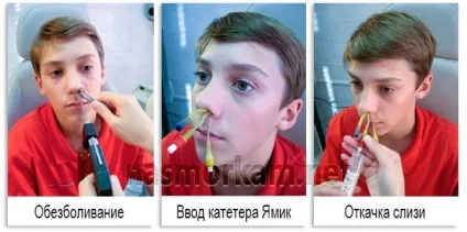 ЯМІК процедура при гаймориті
