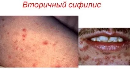 Вторинний сифіліс ознаки, симптоми, фото, лікування (лікування) Вторинний сифіліс ознаки, симптоми, фото, лікування