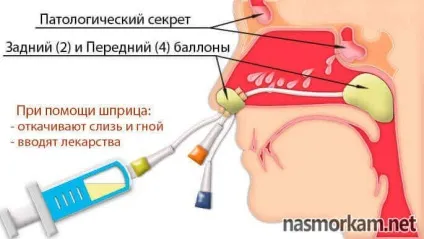 ЯМІК процедура при гаймориті