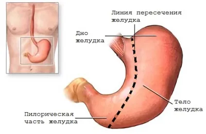 Виразка шлунка як розвивається і в яких випадках потрібна операція (виразка) Виразка шлунка як розвивається і в яких випадках потрібна операція