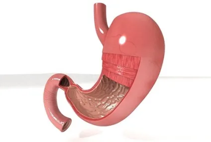Виразка шлунка як розвивається і в яких випадках потрібна операція (усунення виразкової хвороби) Виразка шлунка як розвивається і в яких випадках потрібна операція