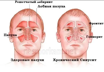 ЯМІК процедура при гаймориті