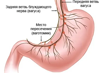 Виразка шлунка як розвивається і в яких випадках потрібна операція (виразка) Виразка шлунка як розвивається і в яких випадках потрібна операція