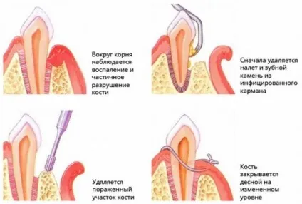 Виразково некротичний гінгівіт клінічна картина, можливі наслідки