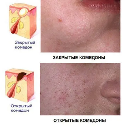 Закриті комедони як з ними боротися (закриті) Закриті комедони як з ними боротися