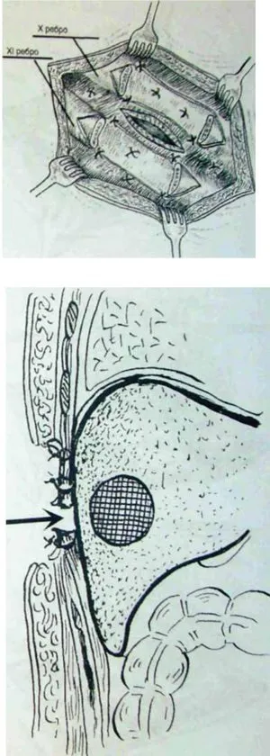 абсцеси печінки
