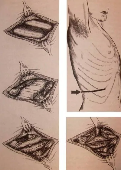 абсцеси печінки