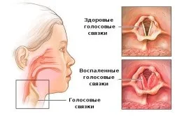 Алергія в горлі симптоми і лікування (лікування) Алергія в горлі симптоми і лікування