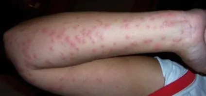 Алергія на укуси постільних клопів як виглядають і як лікувати (фото)