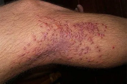 Алергія на укуси клопів симптоми, фото і лікування (клопів) Алергія на укуси клопів симптоми, фото і лікування
