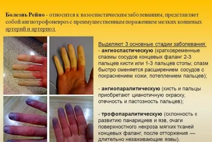 Ангіотрофоневроз кінцівок і внутрішніх органів (синдром Рейно та інші) симптоми і лікування (кінцівок) Ангіотрофоневроз кінцівок і внутрішніх органів (синдром Рейно та інші) симптоми і лікування