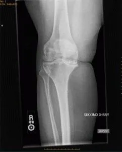 Артроз колінного суглоба 3 ступеня симптоми і лікування (артроз) Артроз колінного суглоба 3 ступеня симптоми і лікування