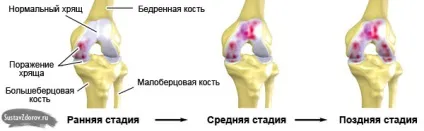 Артроз колінного суглоба 3 ступеня причини, симптоми, лікування (фото)