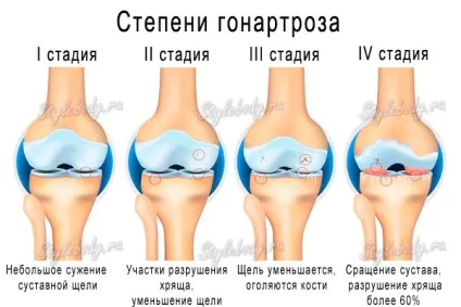 Артроз колінного суглоба (гонартроз) лікування 1, 2, 3 ступенів (лікування) Артроз колінного суглоба (гонартроз) лікування 1, 2, 3 ступенів