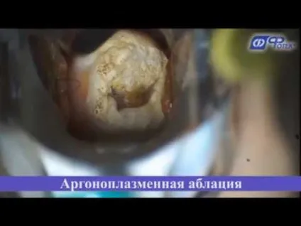 Аргоноплазменной коагуляція шийки матки лікування Сургитрон в гінекології (коагуляція) Аргоноплазменной коагуляція шийки матки лікування Сургитрон в гінекології