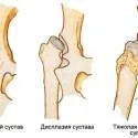 Болить тазова кістка (праворуч, ліворуч) чому і що робити (тазовий) Болить тазова кістка (праворуч, ліворуч) чому і що робити