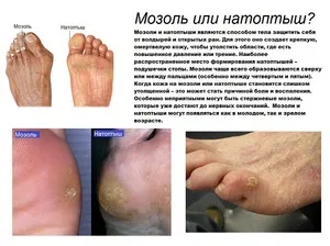 Хвороби стопи ніг у дорослих і дітей (хвороба стопа нога симптом лікування захворювання людина) Хвороби стопи ніг у дорослих і дітей