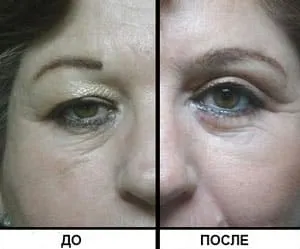 Блефаропластика століття види, фото, протипоказання (фото) Блефаропластика століття види, фото, протипоказання