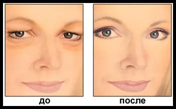 Блефаропластика (пластика повік) в домашніх умовах - пластична хірургія (пластична хірургія) Блефаропластика (пластика повік) в домашніх умовах - пластична хірургія