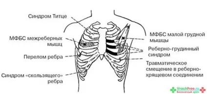 Біль з правого боку грудної клітини - болі в грудях справа, на сьомому небі (клітини) Біль з правого боку грудної клітини - болі в грудях справа, на сьомому небі