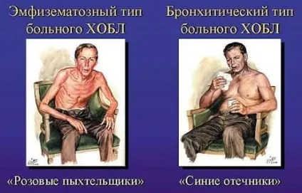 Бронхіт курця симптоми і лікування народними засобами